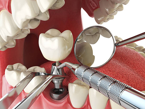 Best Emergency Dentist for Lost Fillings or Crowns in Avilla, IN